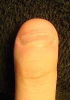 深爪矯正の効果が分かる爪の変化画像