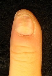 爪がデコボコに生える爪の病気改善