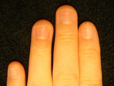 深爪自立矯正の結果　爪の変化画像