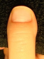 深爪自立矯正の結果　爪の変化画像
