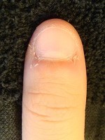 深爪自立矯正の効果　爪の変化画像