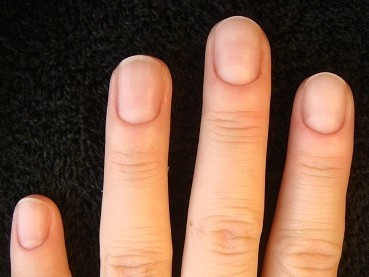 深爪を綺麗な爪にしたい深爪矯正の変化画像
