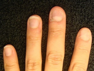 爪の病気でデコボコ　深爪自立矯正の変化画像