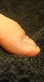 爪の病気でデコボコ　深爪自立矯正の変化画像