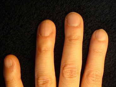 深爪自立矯正と爪の病気を同時に解決　深爪自立矯正変化画像