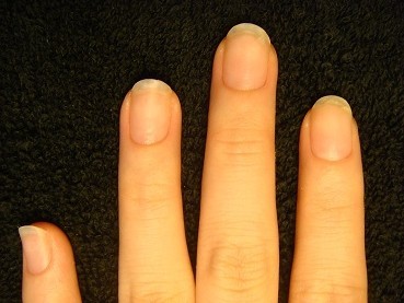 深爪を治したら指先もスラッと綺麗になった深爪矯正変化画像