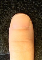 深爪を治したら指先もスラッと綺麗になった深爪矯正変化画像