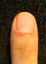 小さい爪が大きく縦長の爪に変化するカイナメソッドの深爪自立矯正