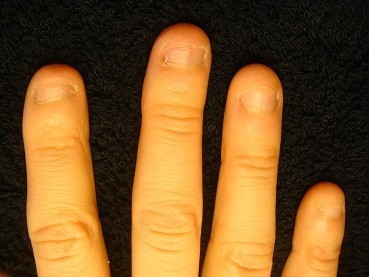 小さい爪が倍以上の長さになった深爪矯正の変化画像