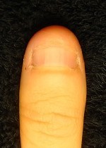 小さい爪が倍以上の長さになった深爪自立 矯正の変化画像