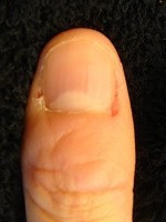 深爪が治るだけでなく指先も変化する！　深爪自立矯正変化画像