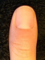 深爪が治るだけでなく指先も変化する！　深爪自立矯正変化画像