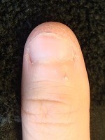 カイナメソッドの深爪矯正は爪が倍になり指先も変わる