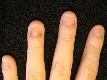 爪のピンクの部分が伸びる深爪自立矯正の効果