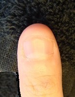 爪のピンクの部分が伸びる深爪自立矯正の効果