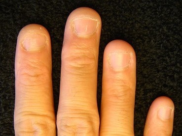 カイナメソッドの深爪矯正は爪も指も変化する