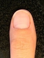 カイナメソッドの深爪矯正は爪も指も変化する