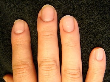 綺麗に伸びない爪を長く改善する深爪自立矯正