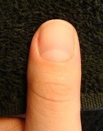 綺麗に伸びない爪を長く改善する深爪自立矯正