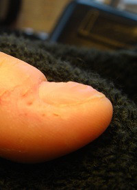 爪のデコボコ改善と爪の病気