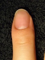 １本からＯＫの深爪矯正の爪の変化画像像