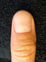 男性の深爪矯正の爪の変化画像