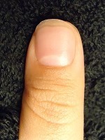 深爪矯正の爪の変化画像