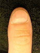 男性の深爪矯正の爪の変化画像