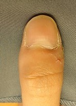 爪の変形の自爪矯正の変化画像