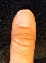 深爪自立矯正　爪の変化画像