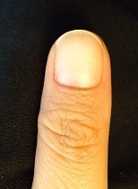 深爪矯正の爪の変化画像