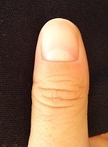 深爪自立矯正卒業　爪の変化画像