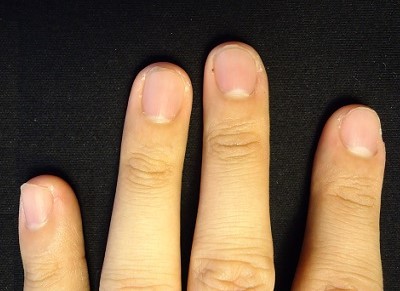 男性の指先の皮膚をむしる癖