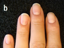 爪の様々な症状のあなたの爪は治る？