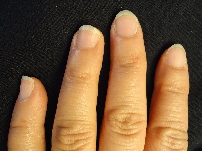 カイナメソッドによる深爪自立矯正卒業　爪の変化画像