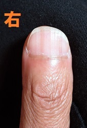 カイナメソッドによる深爪自立矯正を卒業された男性の爪の変化画像