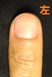 カイナメソッドによる深爪自立矯正を卒業された男性の爪の変化画像