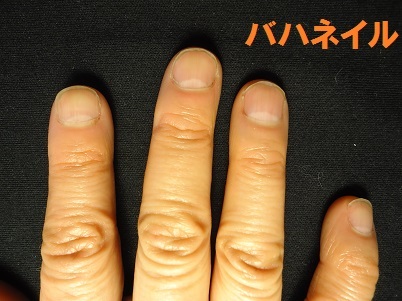 カイナメソッドによる深爪自立矯正を卒業された方の爪の変化画像