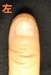 カイナメソッドによる深爪自立矯正を卒業された方の爪の変化画像