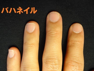 爪をむしる癖の方の深爪矯正による爪の変化画像