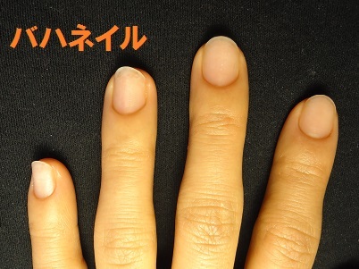爪をむしる癖の方の深爪矯正による爪の変化画像