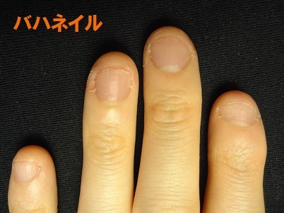 爪をむしる癖が原因の深爪矯正による爪の変化画像　