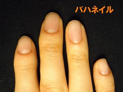 爪をむしる癖が原因の深爪矯正による爪の変化画像　