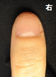 爪をむしる癖が原因の深爪矯正による爪の変化画像