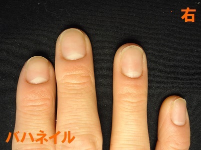爪を噛む癖が原因で深爪になった男性の矯正の変化画像