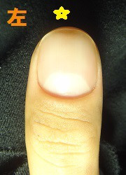 爪を噛む癖からデコボコ爪になった男性の深爪矯正の変化画像
