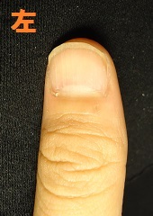 爪を噛む癖から爪がデコボコになり深爪矯正に通われたゲストの変化画像