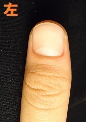 爪を噛む癖から爪がデコボコになり深爪矯正に通われたゲストの変化画像