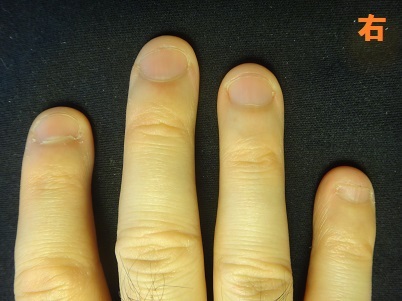 深爪を治した男性の深爪矯正の変化画像