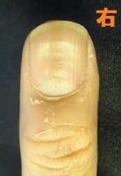 爪のデコボコの原因になる爪噛みも治せる深爪矯正の変化画像